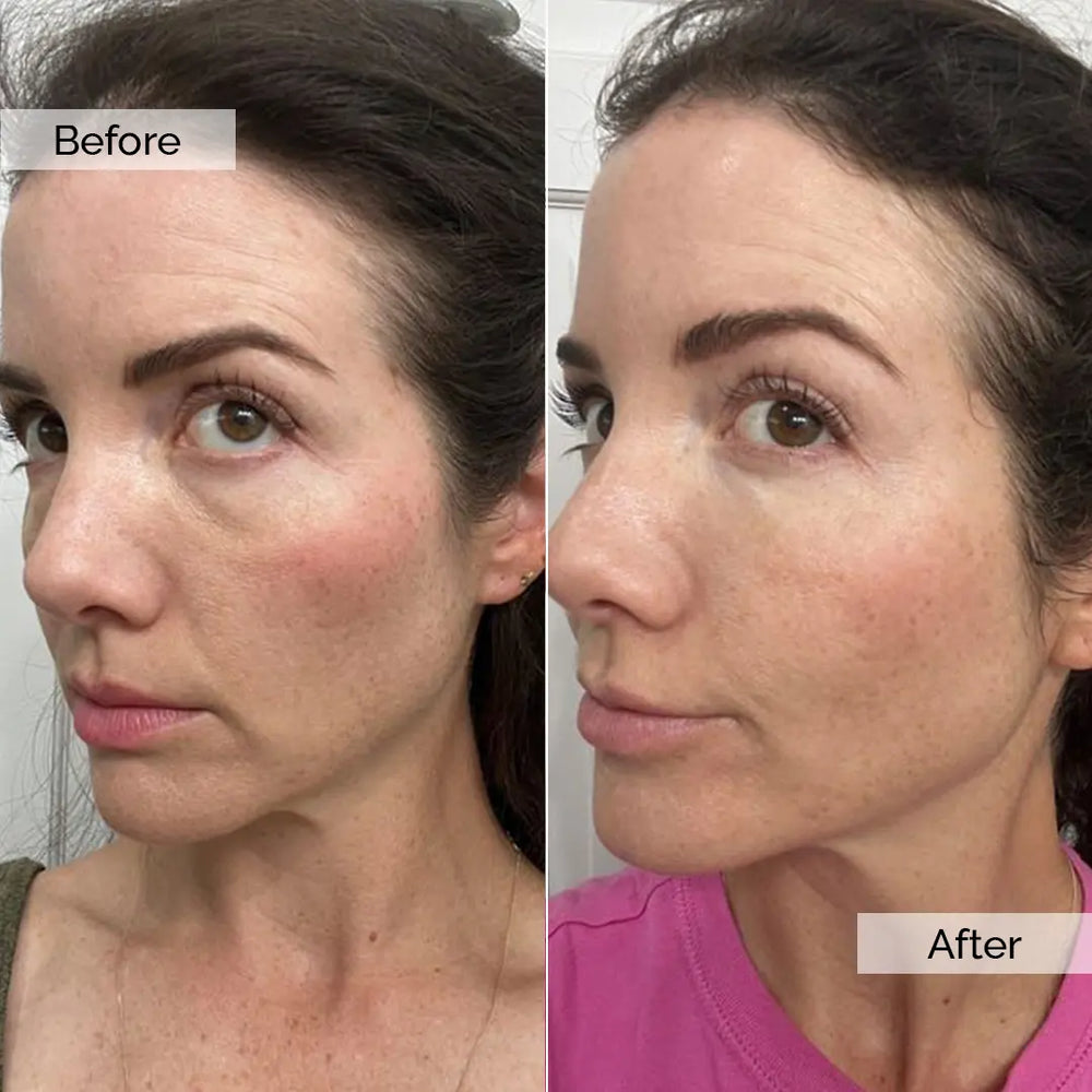 Before and after skincare result