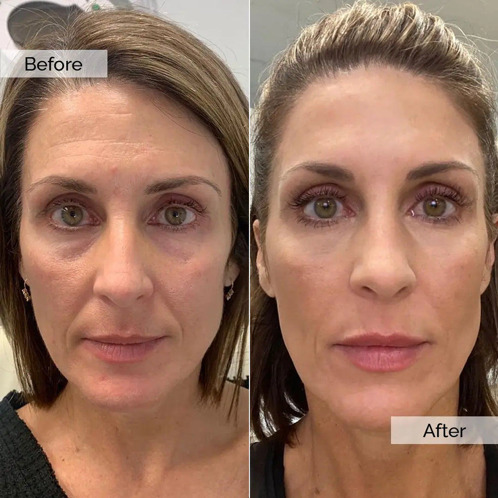 Before and after skincare result